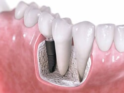 Dental Implant Diagram